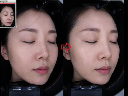 SKINVIVE 施術前後對比 2
