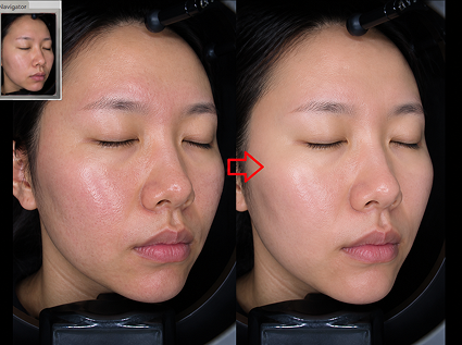 SKINVIVE 施術前後對比 1