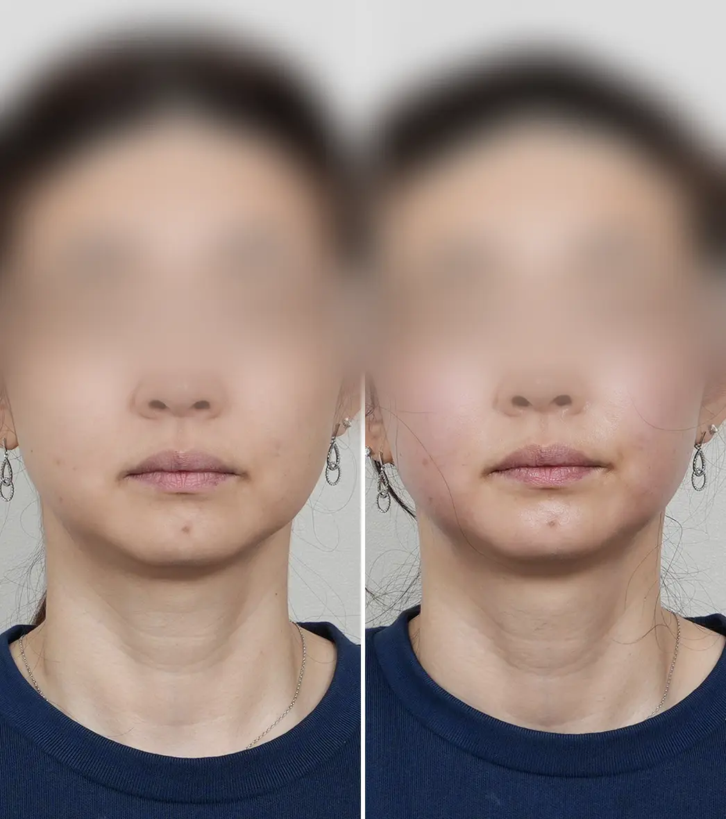 올타이트 시술 전후 정면 비교 — 얼굴 라인 리프팅