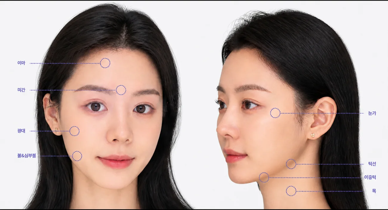 올타이트 시술 필요 부위 맵 — 이마·미간·눈가·광대·팔자·이중턱·목주름