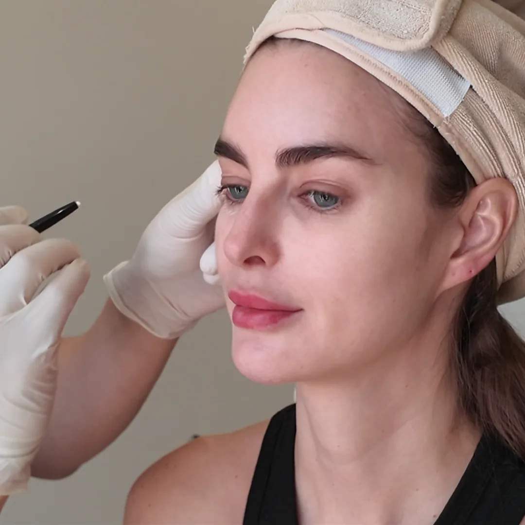A clinician marking the planned area beside the eye before treatment