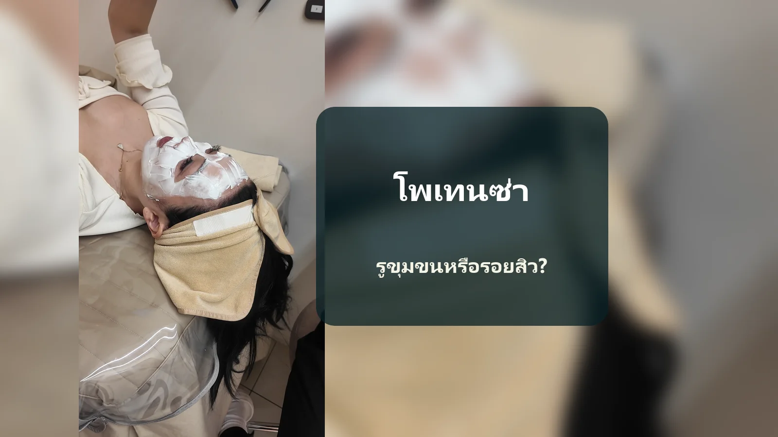รูขุมขนกับรอยสิว ควรเล่าอย่างไรเมื่อปรึกษา Potenza?