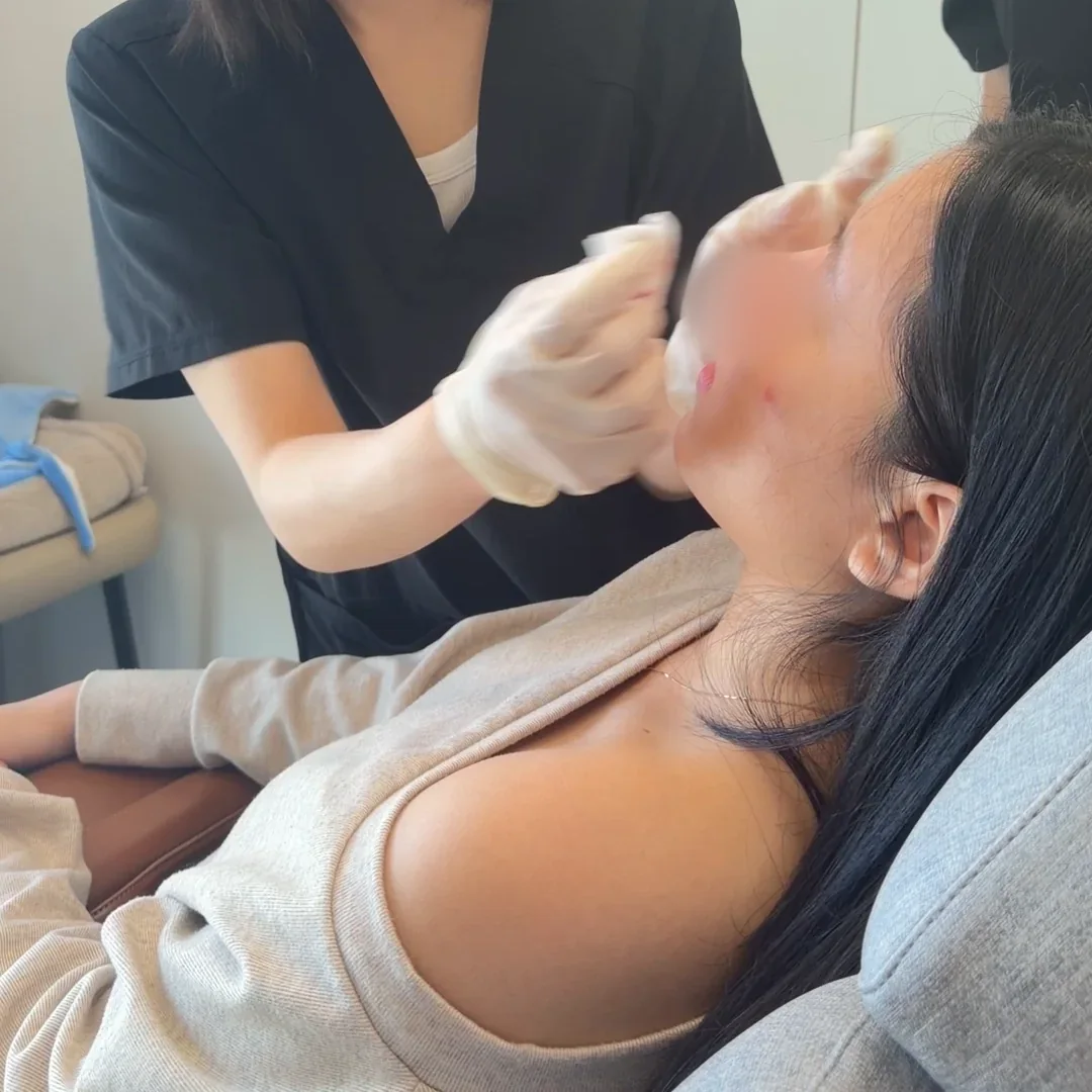 Gloved hands applying gauze to a patient’s nose after an injection