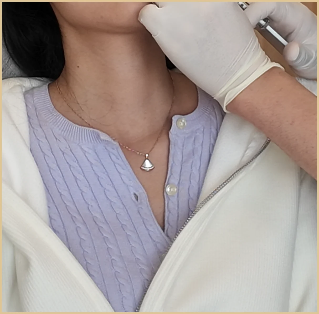 Clinic injection illustration, product not identifiable: a gloved hand holds a syringe beside a patient chin, with the face cropped at the lips