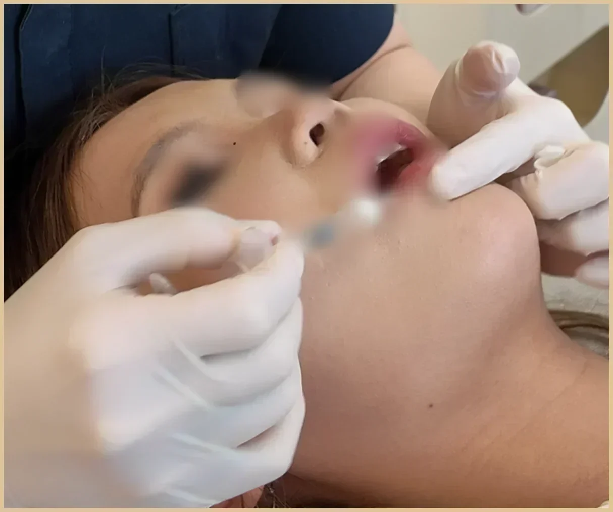 Close-up of a patient lying back with a gloved hand holding a syringe against the cheek beside the lip, needle area blurred