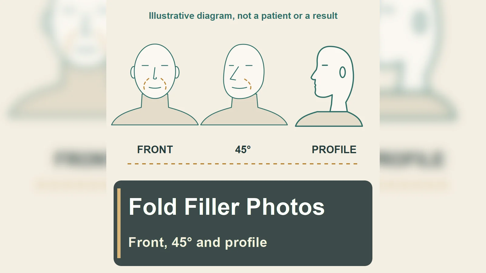 Nasolabial Fold Filler: Fold, Shadow or Diagnosis? Using Front, 45° and Profile Photos