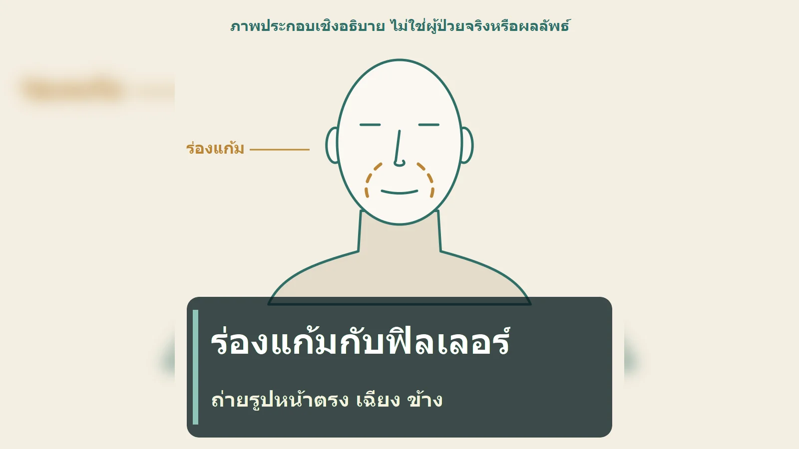 ฟิลเลอร์ร่องแก้ม: เห็นร่องหรือเงา ไม่เท่ากับการวินิจฉัย ดูรูปหน้าตรง เฉียง 45 องศา และด้านข้างอย่างไร